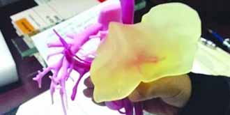 母亲捐肝给10岁儿子 3D打印帮母子成功“拼肝”