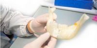 首例3D打印人工下颌在韩国移植成功