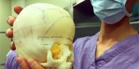 8个月大小孩患上狭颅症 医生借助3D打印建模为其“补颅”成功